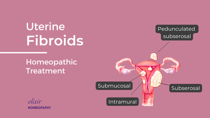 (Homeopathy Treatment) For Uterine Fibroids – Elixir Homeopathy