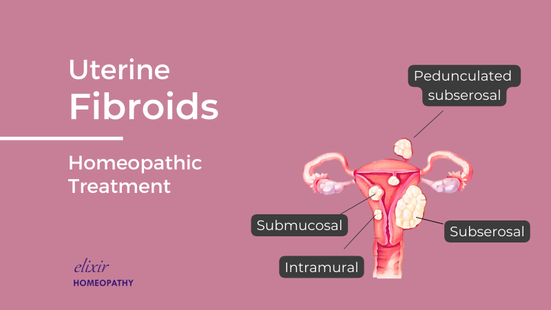 Title image for blog article on homeopathic treatment of uterine fibroids written by Dr. Sanchita Dharne. Dr. Sanchita Dharne is a leading homeopath for treatment of uterine fibroids in Delhi NCR and Gurgaon area.