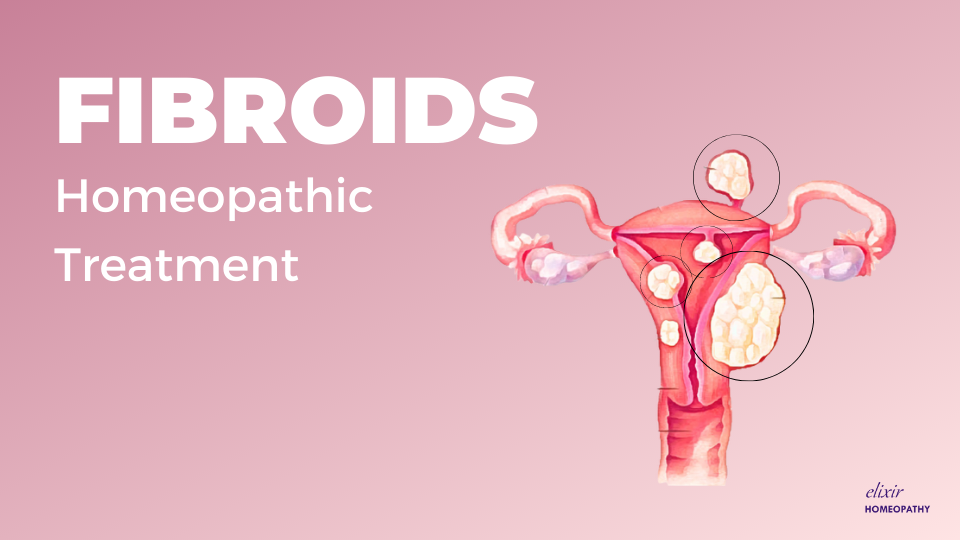 Cover image for article on "Homeopathic Treatment for Uterine Fibroids" by Dr. Sanchita Dharne at Elixir Homeopathy Delhi Gurgaon area. She is best doctor for homeopathic treatment of uterine fibroids.